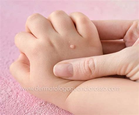 Dermatologia Pediatrica A Sant Ippolito E Fossombrone Dott Ssa