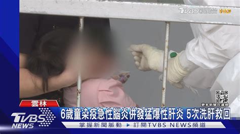 6歲童染疫急性腦炎併發猛爆性肝炎 5次洗肝救回｜tvbs新聞 Youtube