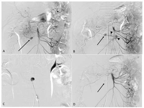 Percutaneous N Butyl Cyanoacrylate Embolization For Treating Ruptured