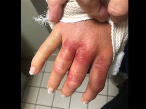 Woman Almost Loses Arm From Flesh Eating Bacteria After Nail Salon Trip