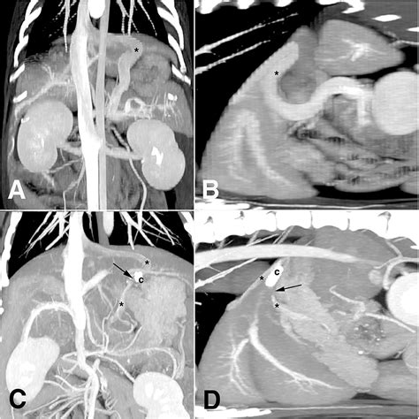 frontiers laparoscopic attenuation   congenital extrahepatic