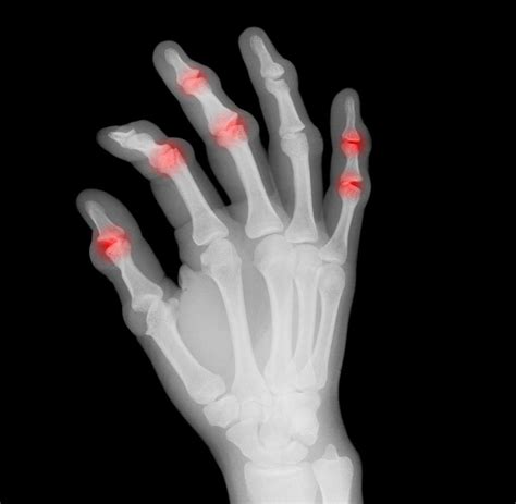 RheumaTrack RA App für eine bessere Arthritis Behandlung WELT