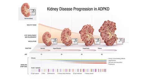 Medical Illustration: Kidney Disease Progression in ADPKD | Medical ...