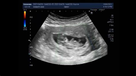 Ultrasound Video Showing Single Fetal Death In Twin Pregnancies Called