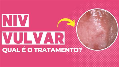 Qual O Tratamento Da Niv Vulvar Youtube