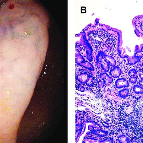 A Mucosal Irregularity In Antrum B Chronic Active Gastritis With Download Scientific Diagram