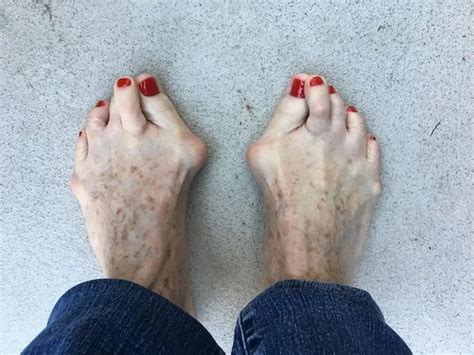 Top 63 Des Pieds Les Plus Moches Du Monde