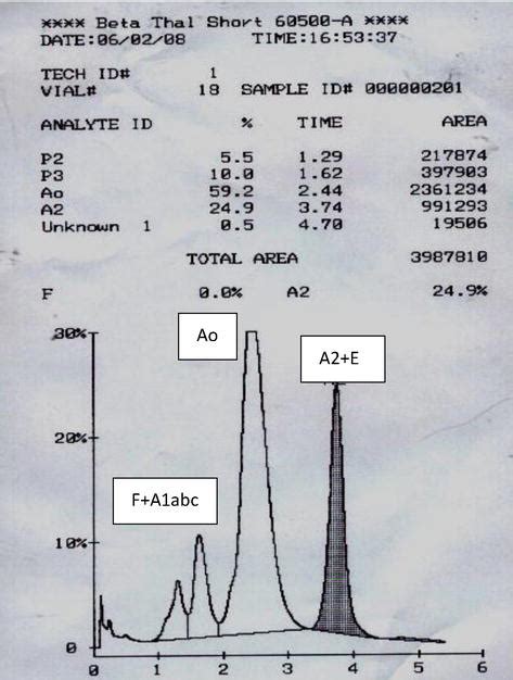 Detection Of Abnormal Hemoglobin Variants By HPLC Method 44 OFF