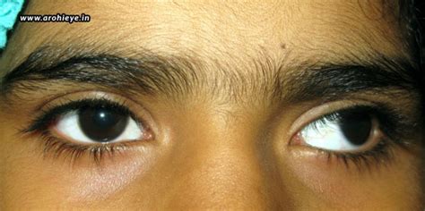 Squint – Symptoms, Causes, And Treatments – Arohi Eye Hospital