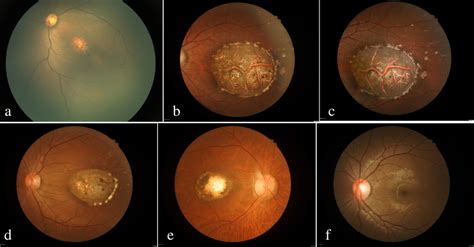 a, b, d, e sequentially show the fundus photographs of P1-4; (c) c is ...