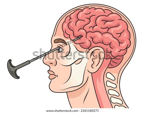 Lobotomy Before And After Brain