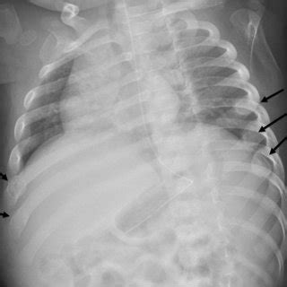 Abusive Head Trauma In A Month Old Boy A Sagittal Mri Of The Spine