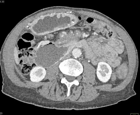 Adenocarcinoma Body Of Pancreas With Vascular Invasion Pancreas Case