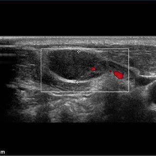 A neck ultrasound showing an enlarged lymph node which measures 1.9 cm ...