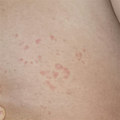 Inner Thigh Rash Spots Won T Go Away What Is This R Dermatologyquestions