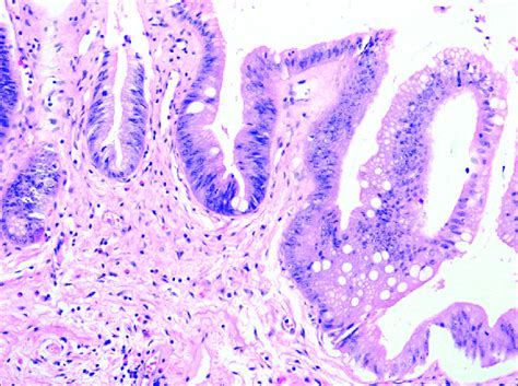 Intestinal Metaplasia In Gallbladder Epithelium Hand X400 Download