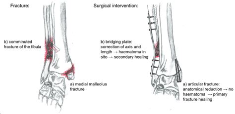 Avulsion Fracture Ankle Lateral Malleolus / Find all the fractures ...