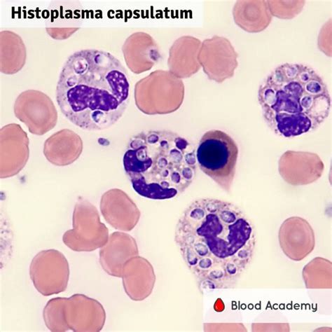 Histoplasma capsulatum - Blood Academy