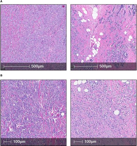 Frontiers Exploration Of Cancer Associated Fibroblasts Phenotypes In