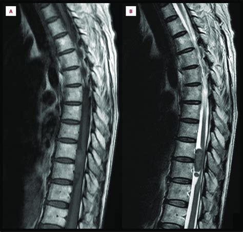 Thoracic Spine Magnetic Resonance Imaging Showing An Intraspinal Mass