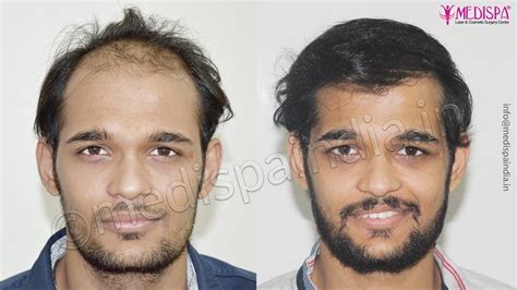 Hair Transplant Surgery Results Before And After Photos Top Hair