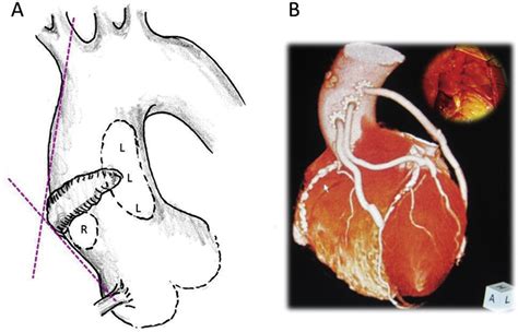 Patency Of Saphenous Vein Grafts Using The Pas Port System During