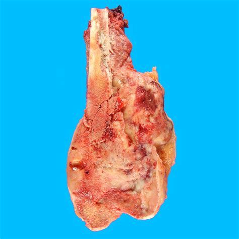 Histology Of Osteosarcoma