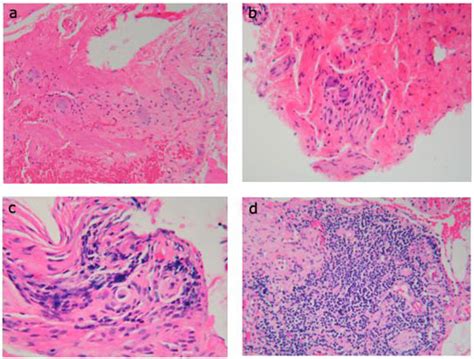 Figure 6 Pathophysiology Of Achalasia And Diffuse Esophageal Spasm