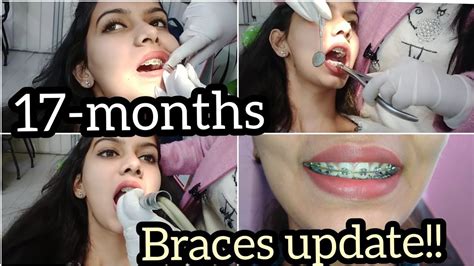 17 Months Braces Update Braces Tightening Vlog Braces