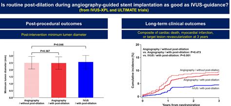 Is Routine Postdilation During Angiography Guided Stent Implantation As