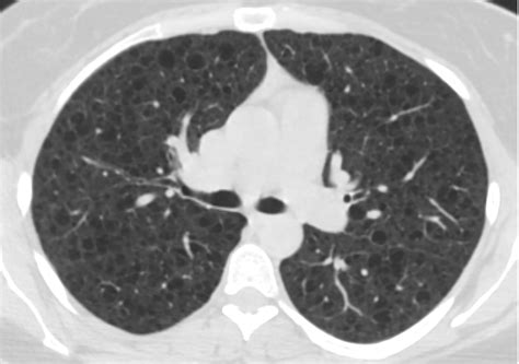 Management Of Pneumothorax What Is The Best Strategy The LAM