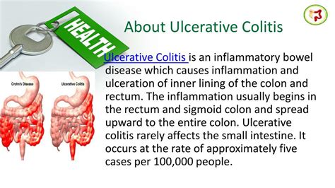 Ppt Take Ayurveda Based Ulcerative Colitis Treatment By Dr Harish