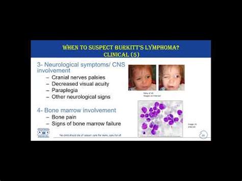 Diagnosis And Referral Of Burkitts Lymphoma Youtube