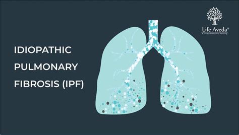 Idiopathic Pulmonary Fibrosis