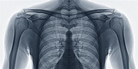 Chest Wall Surgery | Thoracic & Esophageal Surgery| For Clinicians ...