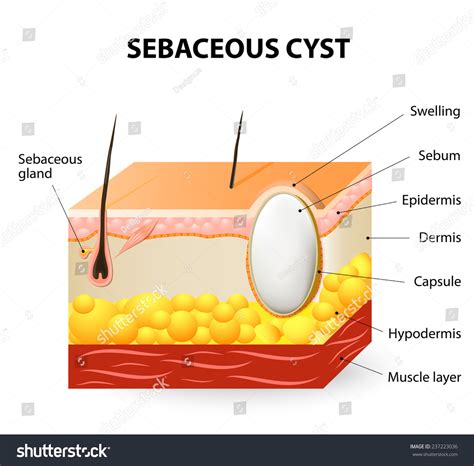 Sebaceous Cyst Ultrasound