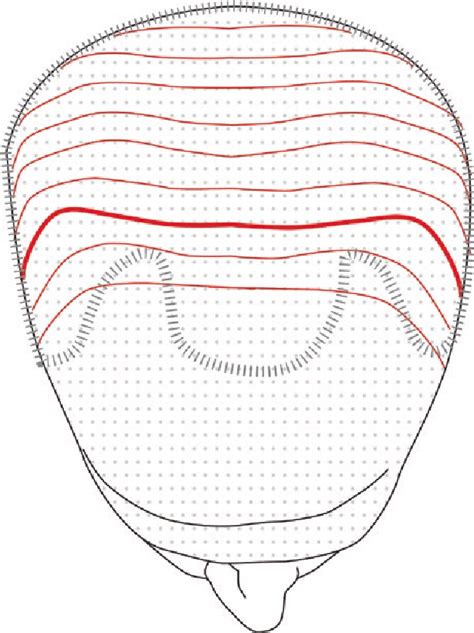 Biodynamic Excisional Skin Tension Lines for Cutaneous Surgery ...