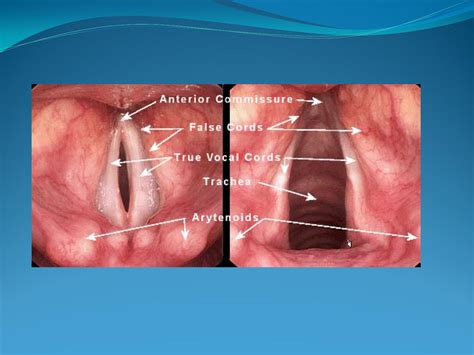 Cancêr de LARINGE Fisioterapia Clinica em Oncologia