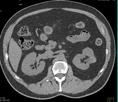 Post Cryoablation Changes Left Kidney - Kidney Case Studies - CTisus CT ...