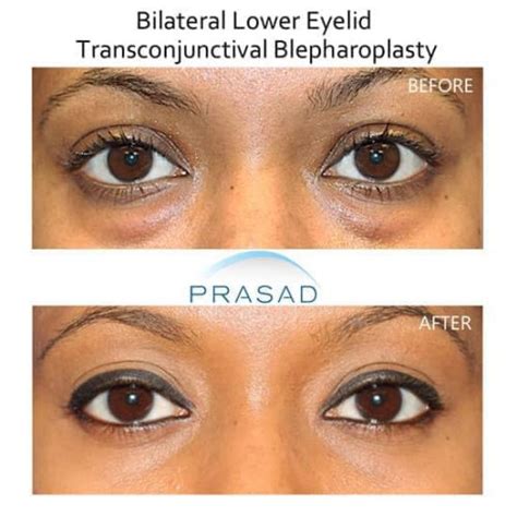 How Safe Is Under Eye Bag Removal Surgery Dr Prasad Blog