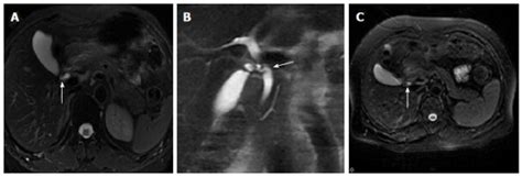 Common Bile Duct Diameter In An Asymptomatic Population A Magnetic