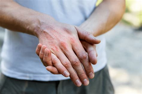 Ausschlag durch Allergie Auslöser Diagnose Behandlung kiweno