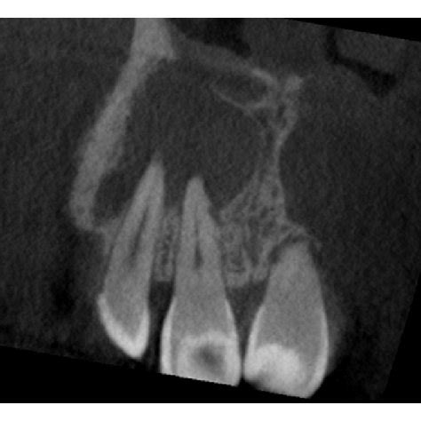 Pre Operative IOPA Radiograph Showing Well Defined Large Periapical