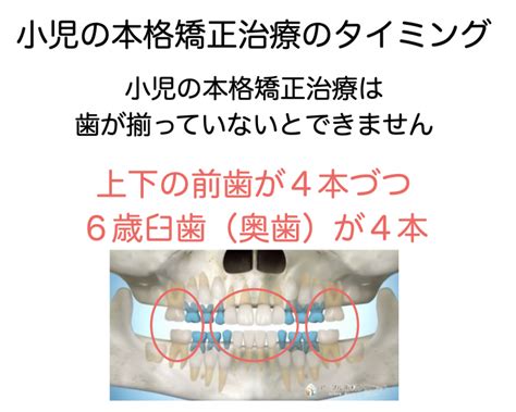 小児矯正治療費のご案内（プレオルソ矯正治療と拡大床矯正治療のタイミング） アーブル歯科クリニック