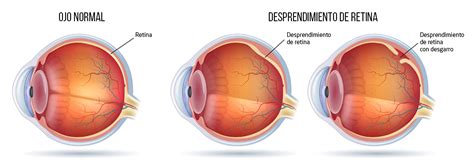 Desprendimiento De Retina Clínica De Oftalmología Sánchez Trancón