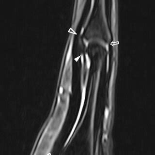 Volar plate anatomy on the proximal and distal interphalangeal and ...