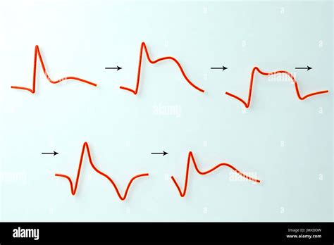 Myocardial Infarction Fotografías E Imágenes De Alta Resolución Alamy