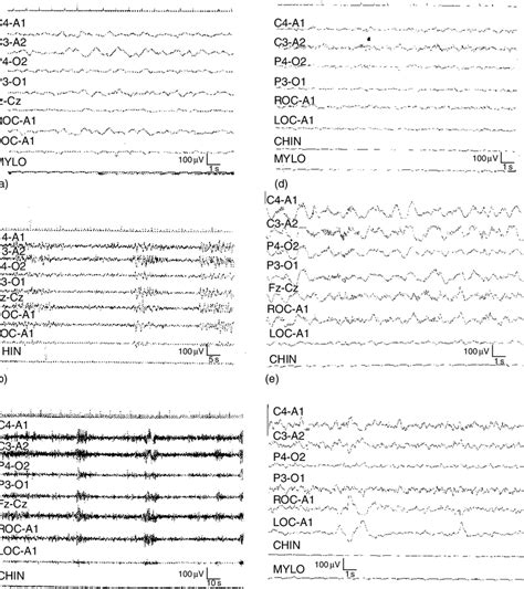 Posttraumatic Sleep Organization And Its Prognostic Value 24 H