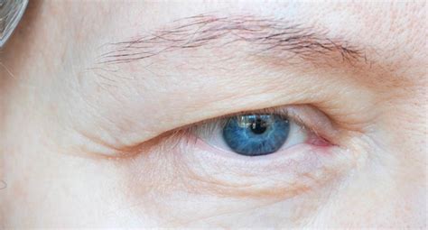 All You Need To Know About Droopy Eyelid Surgery In London