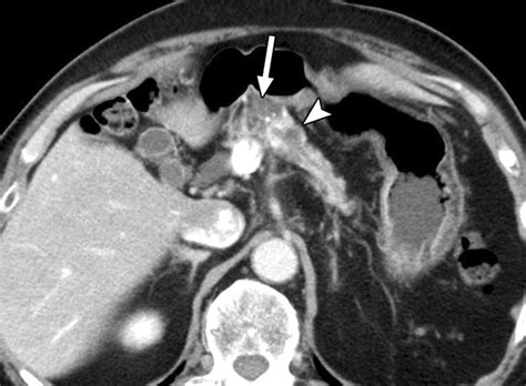 Pancreatic Surgery For The Radiologist 2011 An Illustrated Review Of